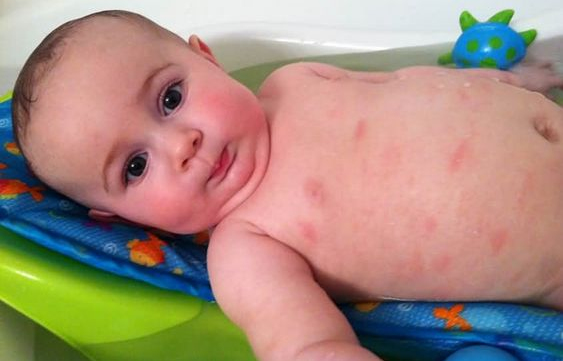 家有過敏體質(zhì)的寶寶看過來，容易引起過敏的食物清單大放送