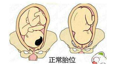 中醫(yī)教你如何按摩至陰穴矯正胎位? 較正的胎位