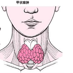 甲狀腺腫大別擔(dān)心？中醫(yī)