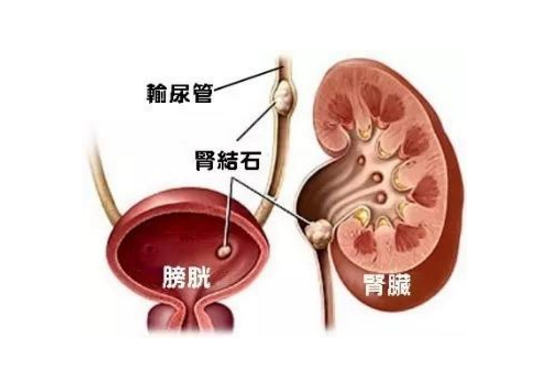 從尿液看腎臟健康,這些腎病癥狀你有嗎? 腎病患者的飲食調(diào)養(yǎng)