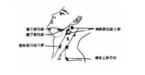 身體出現(xiàn)以下癥狀要當(dāng)心了!是淋巴癌的早期癥狀,別不當(dāng)一回事? 淋巴癌!