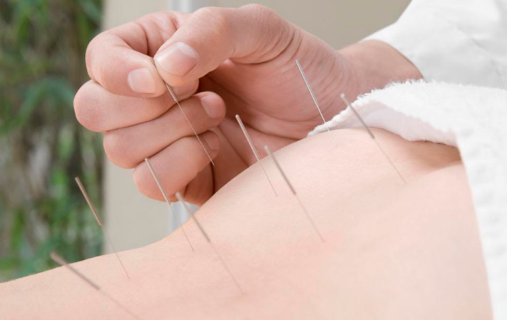 中醫(yī)針灸的特點(diǎn)